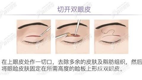 开眼角眼睛会变大是真的吗？